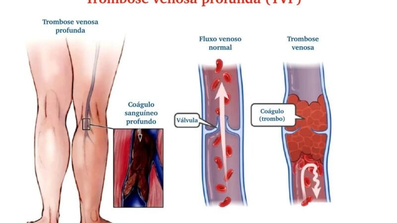 Trombose venosa: a complicação mais temida das varizes
